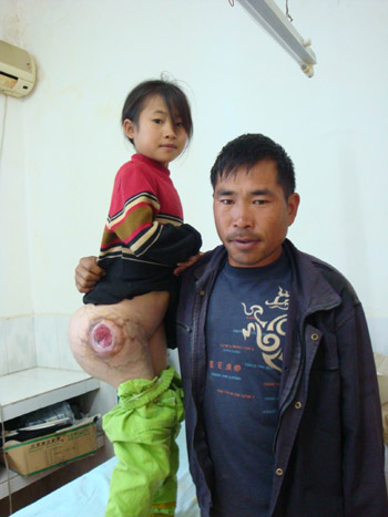 瑤家囡身長(zhǎng)巨瘤八年引發(fā)“愛(ài)心接力”(組圖)