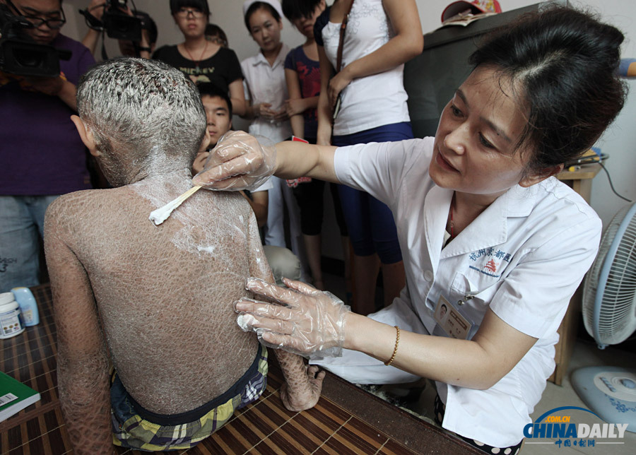 浙江溫嶺：“樹皮娃娃”渴望快樂(lè)童年