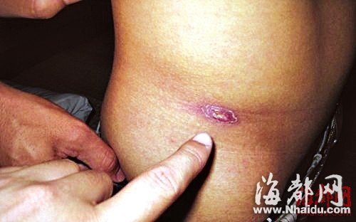 閩現(xiàn)多起恙蟲病例 廈門一男子險(xiǎn)喪命