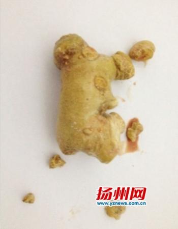 男子腎內(nèi)取出一塊