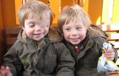 英國男童天生“半臉” 同胞兄弟情令人動容